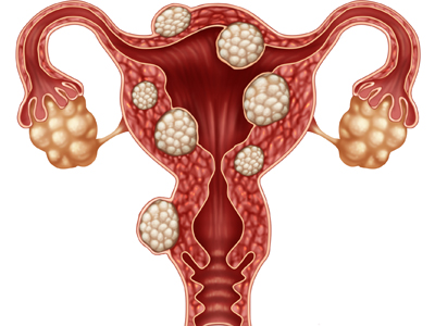 Wenn Endometriose ein Hindernis ist, schwanger zu werden.